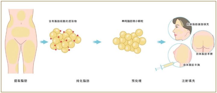 吸脂塑形_面部吸脂瘦脸会反弹吗_吸脂减肥与体型雕塑术