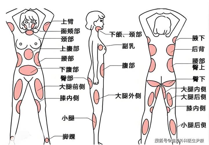 做完臀部吸脂怀孕后会反弹吗_吸脂手术禁忌部位_吸脂减肥后会不会反弹