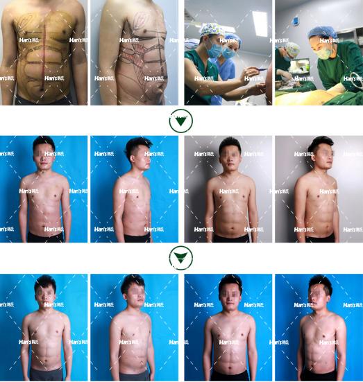 做完臀部吸脂怀孕后会反弹吗_吸脂减肥后会不会反弹_吸脂手术禁忌部位